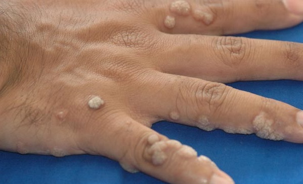 Home Remedies to Remove Warts on Fingers | LIVESTRONG.COM