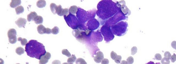 komórki raka